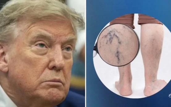 Insuficiência venosa crônica: Entenda detalhes da doença que afeta Donald Trump