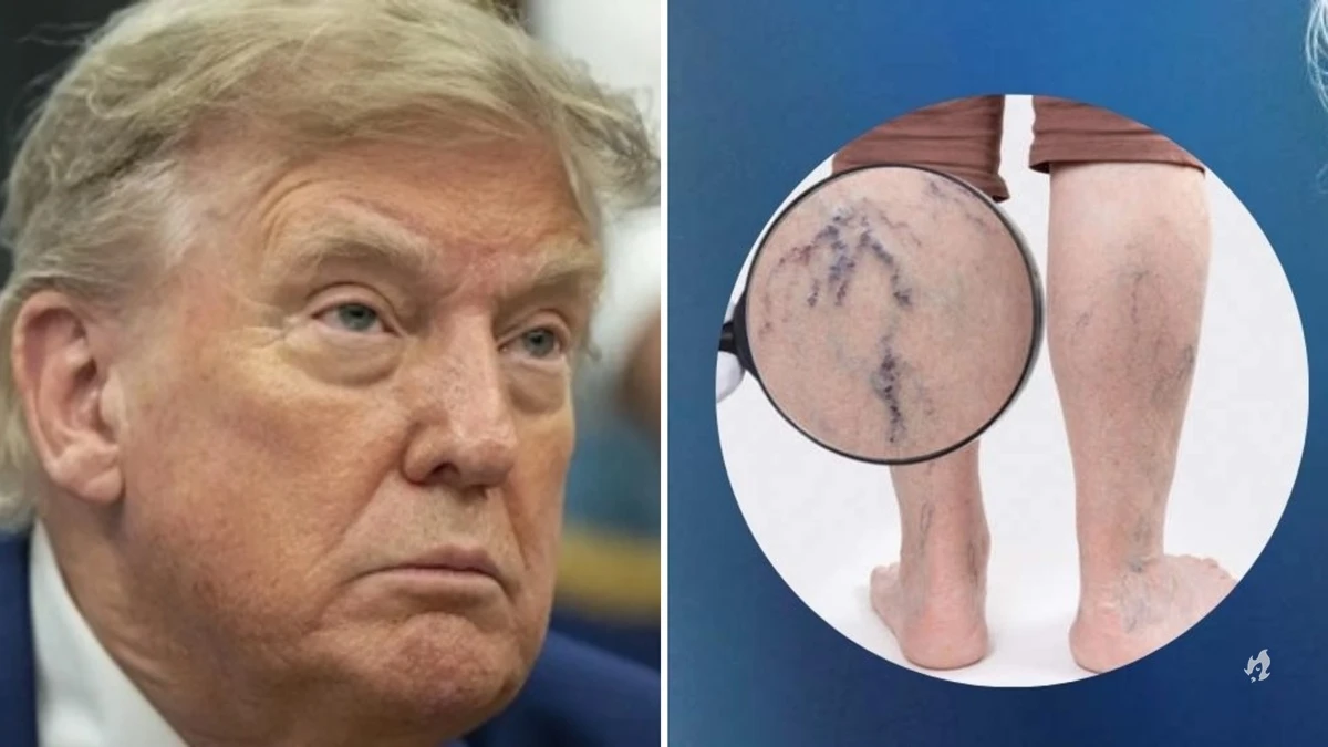 Insuficiência venosa crônica: Entenda detalhes da doença que afeta Donald Trump
